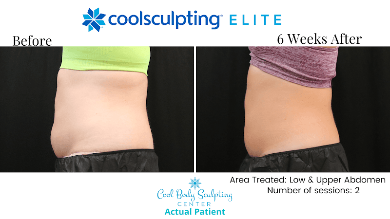 Cool Body Sculpting Center clinic