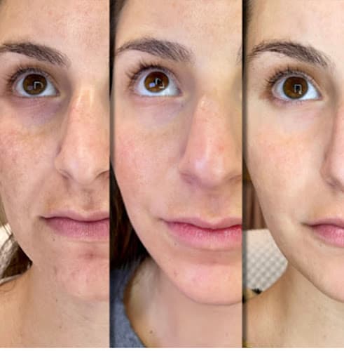 Collagen Bar NYC Microneedling and Body Contouring clinic